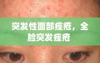 突发性面部痤疮,全脸突发痤疮