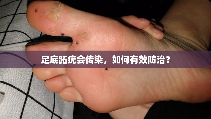 足底跖疣会传染，如何有效防治？